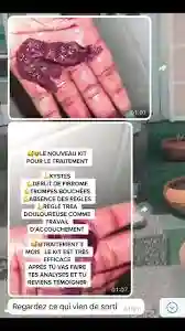 Traitement des Trompes Bouchées - Vue 1
